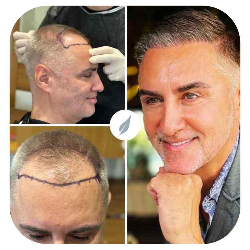 Hair Transplant Before After Turkey | Vita Estetic