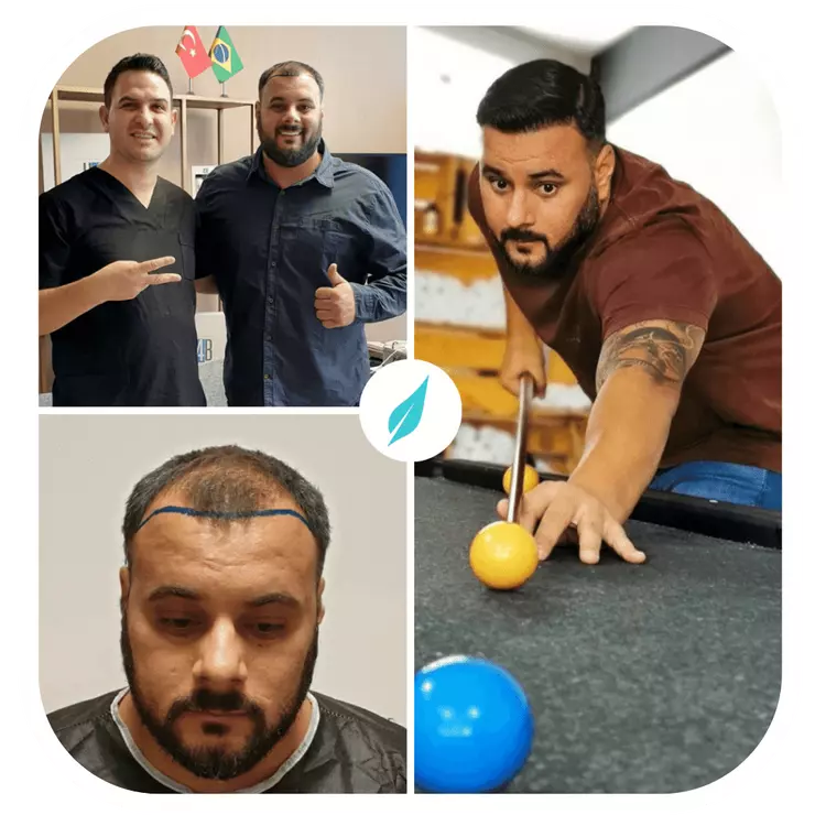 hair-transplant-before-after-dr-kinyas-vita-estetic