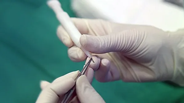 DHI Hair Transplant | Choi-Pen
