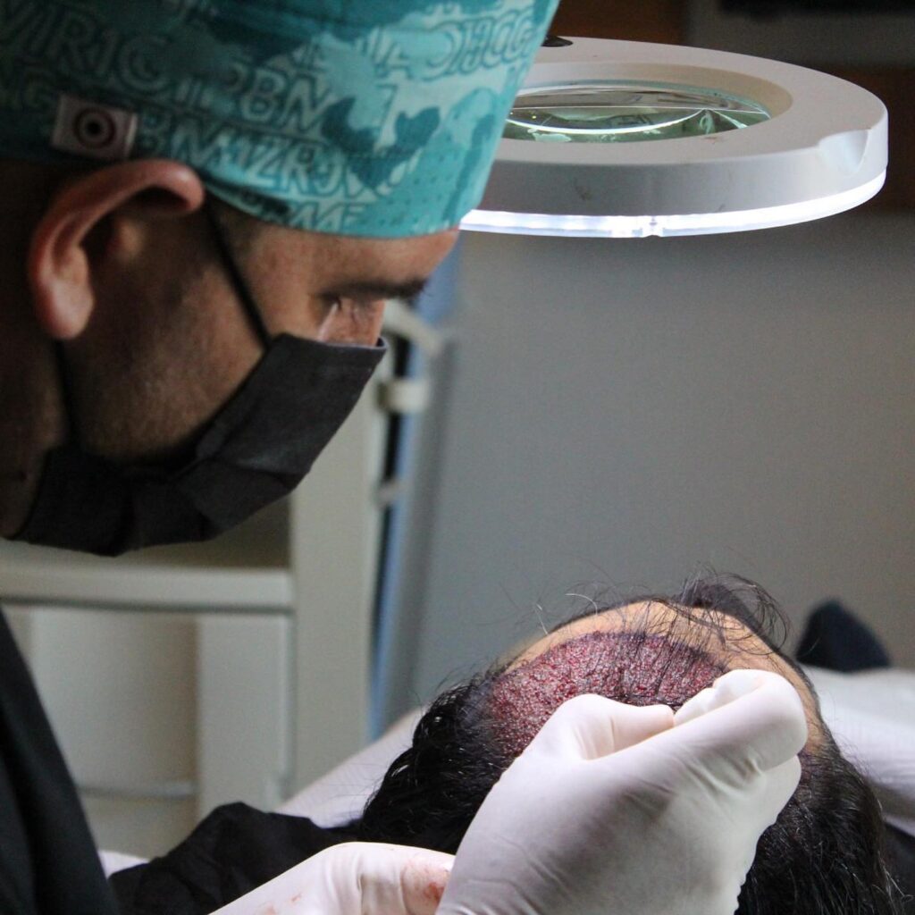 Hair Transplant in Turkey Hair Transpant in Turkey - Dr Kinyas Dusunmez