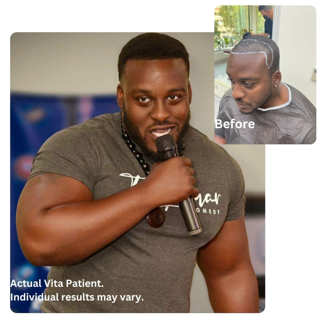 1 year results after hair transplant in Turkey