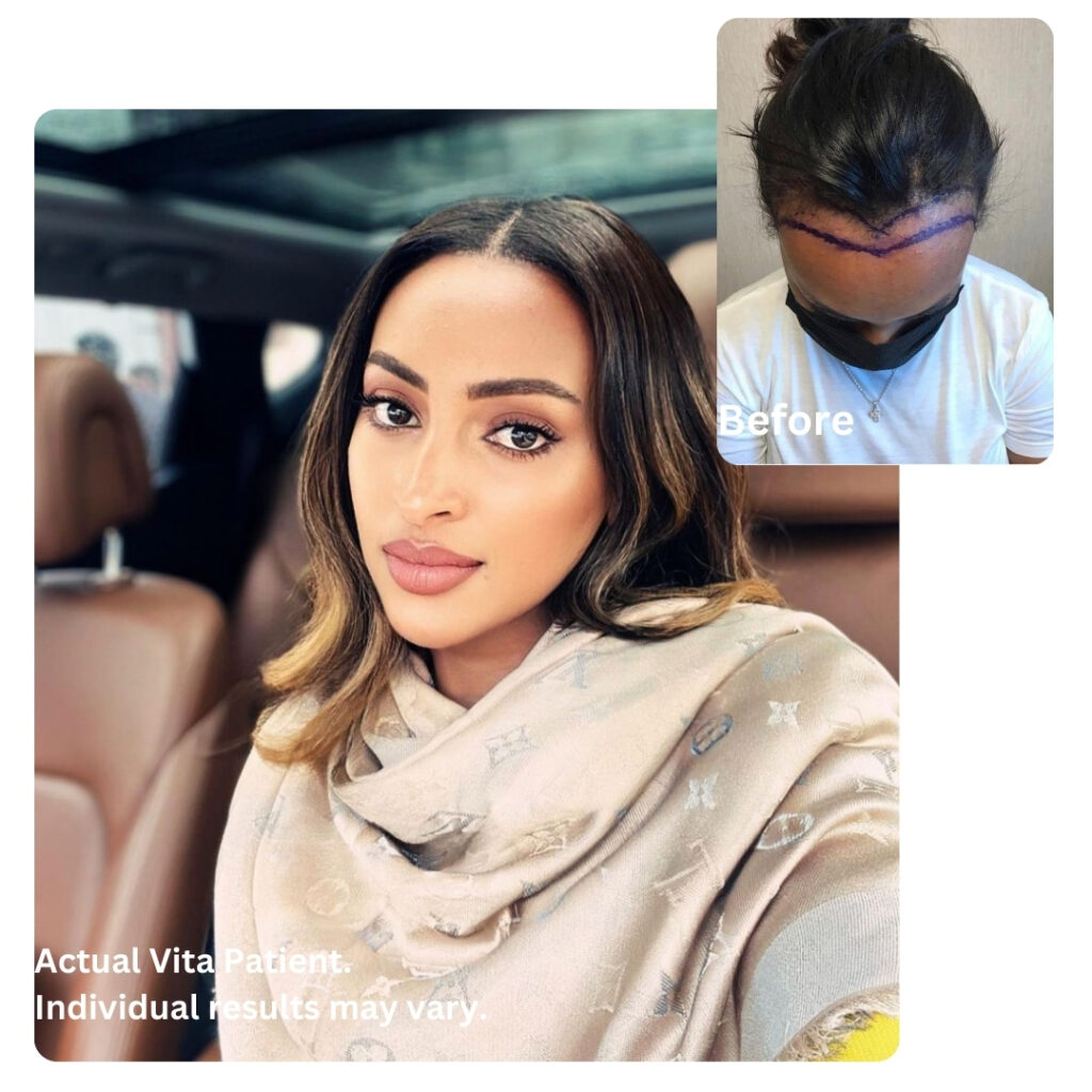 Female Hair transplant in Turkey