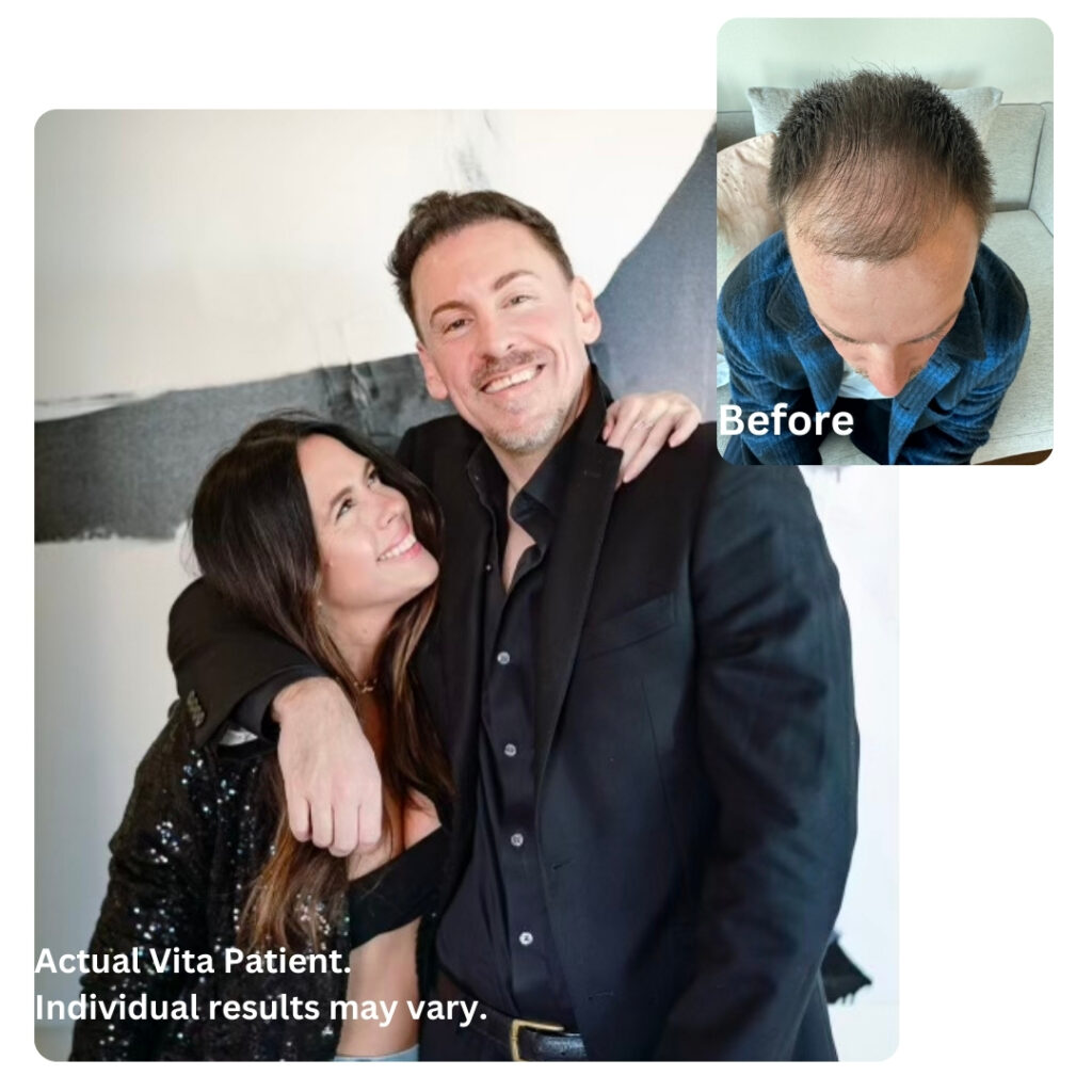 Leon's 6th Month's Results After His Hair Transplant in Turkey