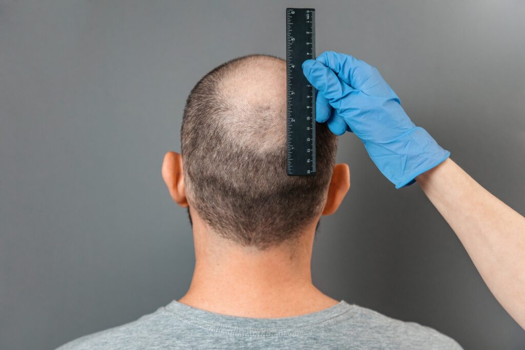 crown area balding Bald Spot on the Crown: What Really Works and What Doesn't
