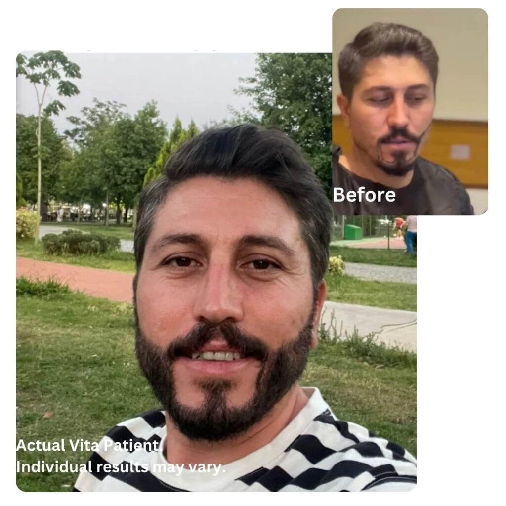 Beard Transplant in Turkey before after