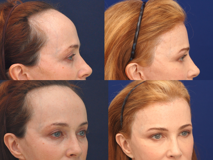 Forehead reduction surgery before and after