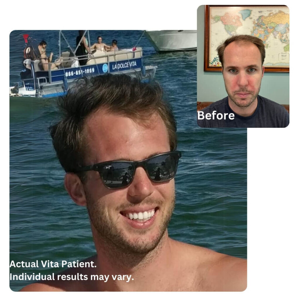 8 months after hair transplant in Turkey