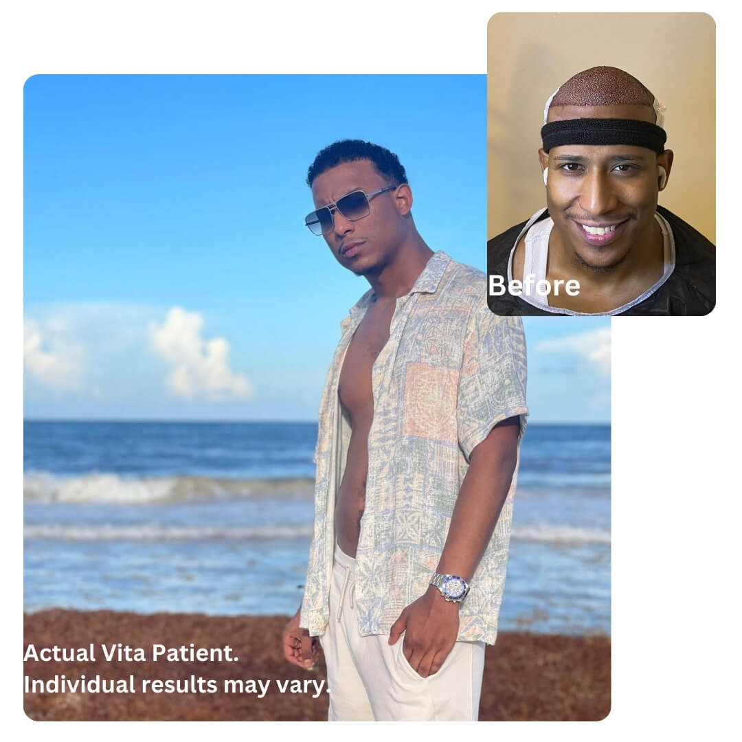 Hair Transplant in Turkey before after