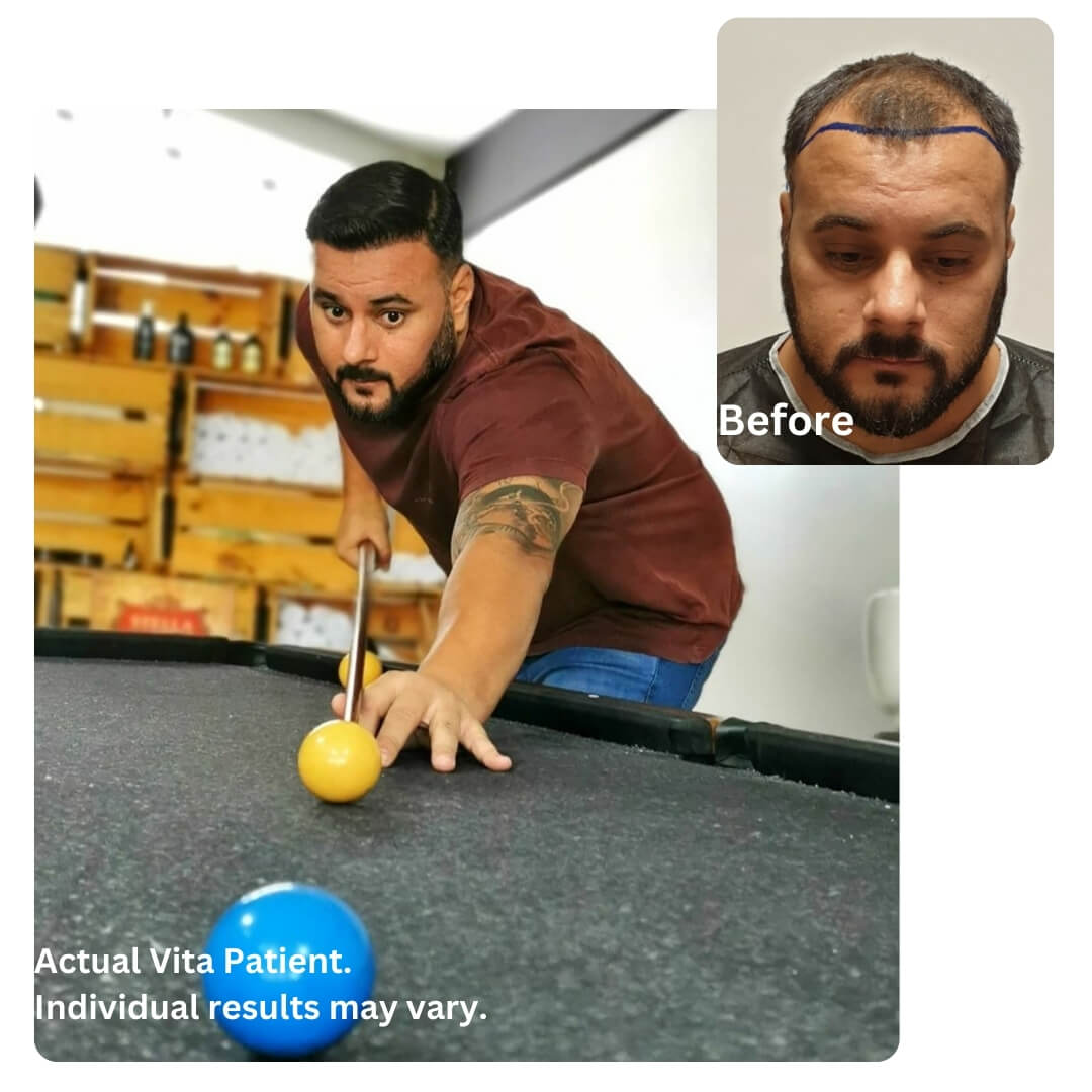 Hair Transplant in Turkey before after