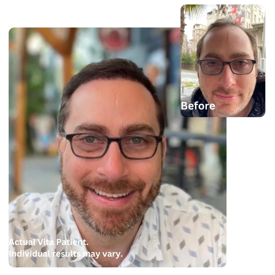 10 months results after DHI Hair transplant in Turkey