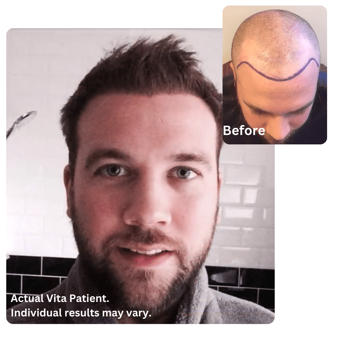 Hair Transplant in Turkey before after