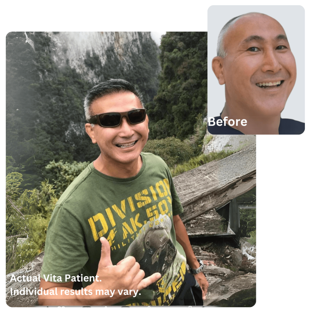 Hair Transplant in Turkey Before After