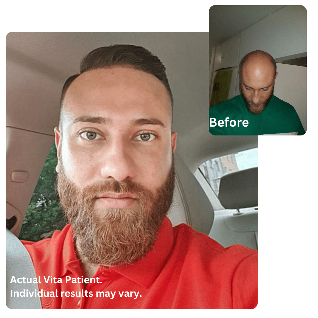 Hair Transplant in Turkey before after
