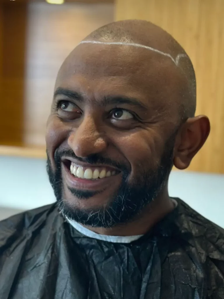 Afro Hair Transplant in Turkey
